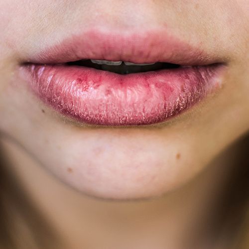 dry lips